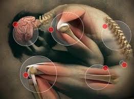 sindrome fibromialgica